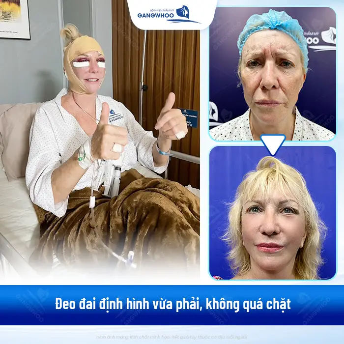 Căng da mặt đeo đai định hình bao lâu? Cách hồi phục an toàn