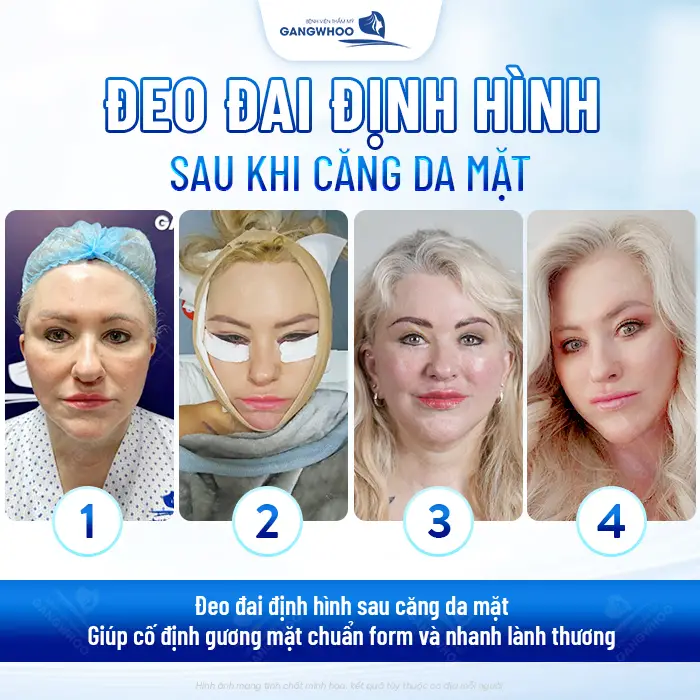 Căng da mặt đeo đai định hình bao lâu? Cách hồi phục an toàn