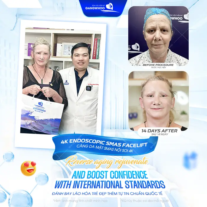 Căng da mặt đeo đai định hình bao lâu? Cách hồi phục an toàn