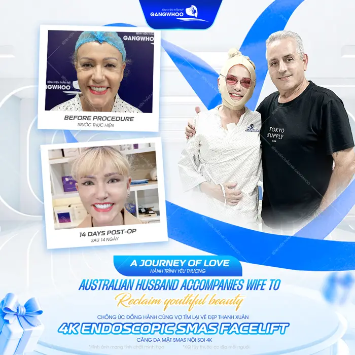 Căng da mặt đeo đai định hình bao lâu? Cách hồi phục an toàn