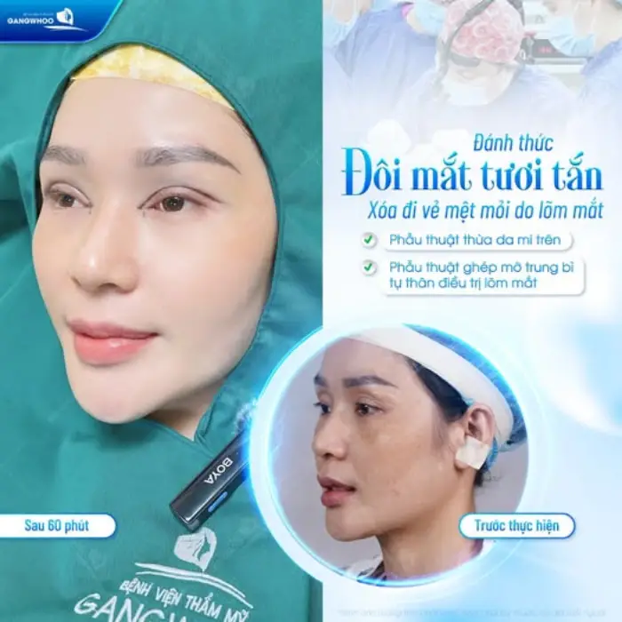 Kết quả cấy mỡ tự thân giúp gương mặt đầy đặn và trẻ trung hơn