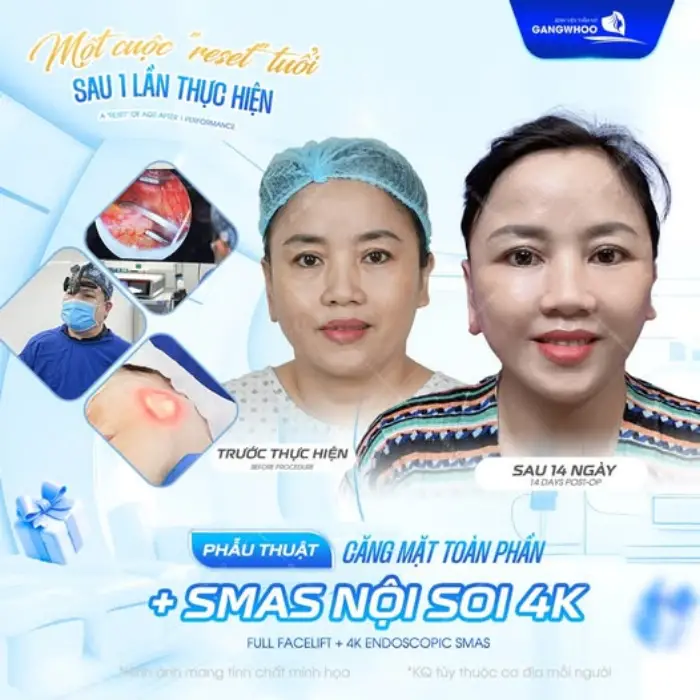 Công nghệ căng da mặt 4D mang lại hiệu quả trẻ hóa tự nhiên