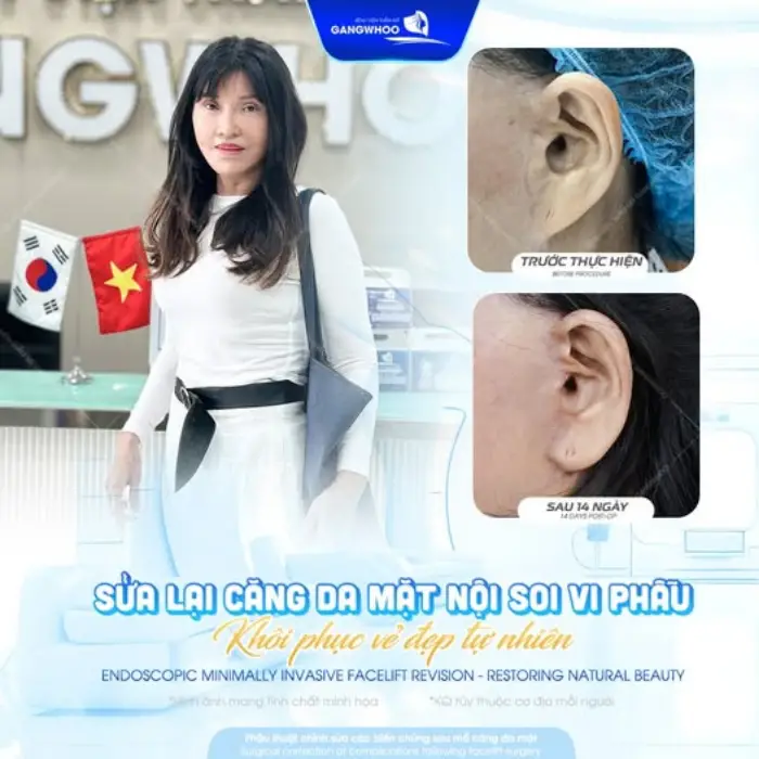 Hình ảnh trước – sau của khách hàng sử dụng công nghệ căng da mặt 4D.