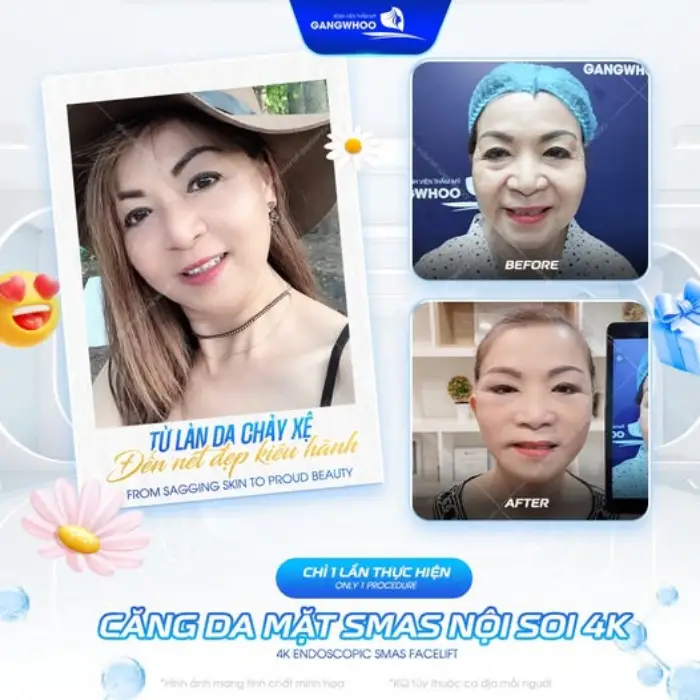 Làn da căng mịn và gương mặt thon gọn hơn sau căng da mặt 4D