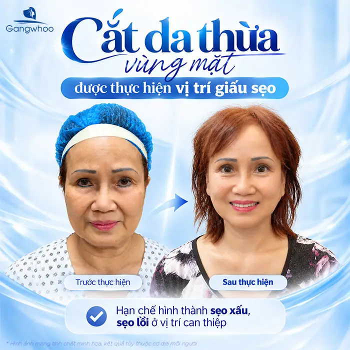 Cắt da thừa vùng mặt: Ưu điểm và quy trình thực hiện