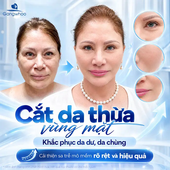 Cắt da thừa vùng mặt: Ưu điểm và quy trình thực hiện