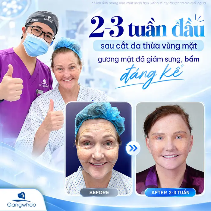 Cắt da thừa vùng mặt: Ưu điểm và quy trình thực hiện