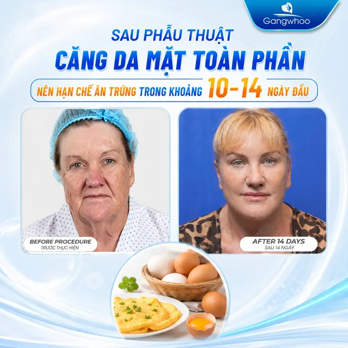 Căng Da Mặt Có Được Ăn Trứng Không? Bác Sĩ Giải Đáp Theo Góc Nhìn Y Khoa