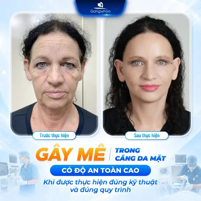 Căng Da Mặt Có Gây Mê Không? Giải Đáp Chi Tiết Từ Bác Sĩ