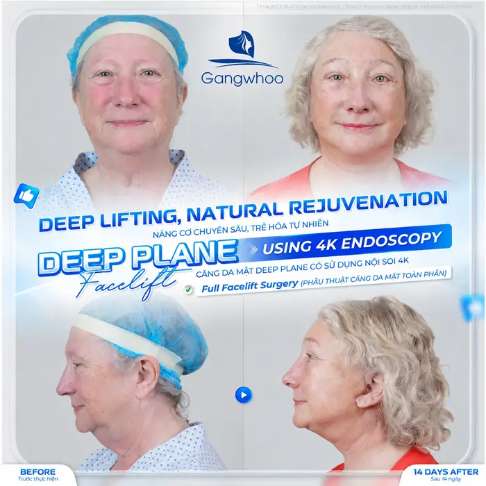 Căng da mặt deep plane là gì? Những điều bạn cần biết