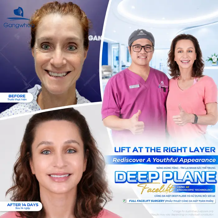 Căng da mặt deep plane là gì? Những điều bạn cần biết