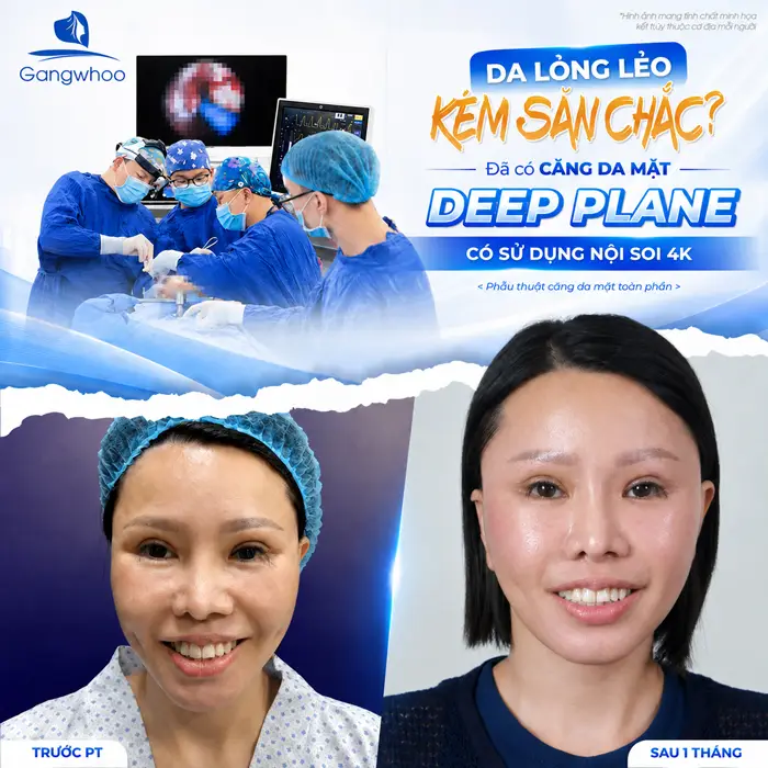 Căng da mặt deep plane là gì? Những điều bạn cần biết