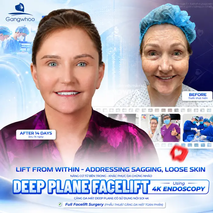Căng da mặt deep plane là gì? Những điều bạn cần biết