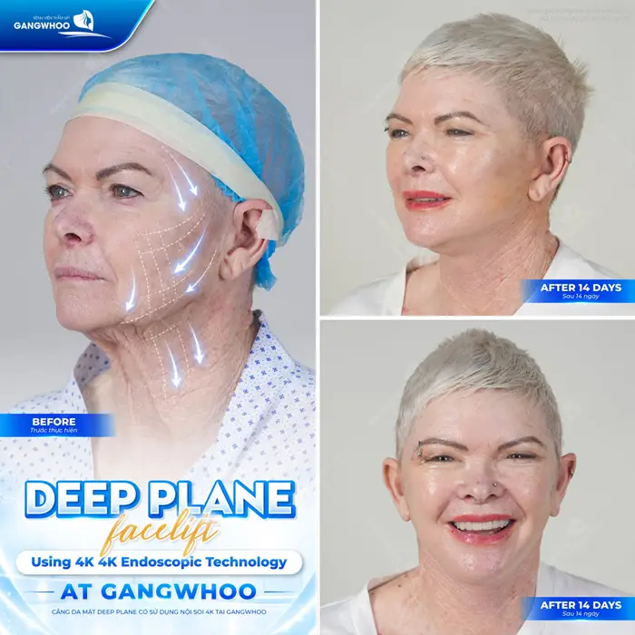 Căng da mặt Deep Plane tại bệnh viện thẩm mỹ Gangwhoo được khách hàng tin tưởng lựa chọn 