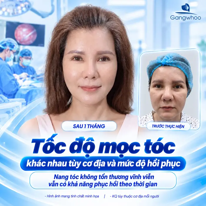 Căng Da Mặt Tóc Bao Lâu Mọc Lại? Bác Sĩ Giải Đáp Chi Tiết Từ Góc Độ Chuyên Môn