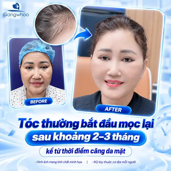 Căng Da Mặt Tóc Bao Lâu Mọc Lại? Bác Sĩ Giải Đáp Chi Tiết Từ Góc Độ Chuyên Môn