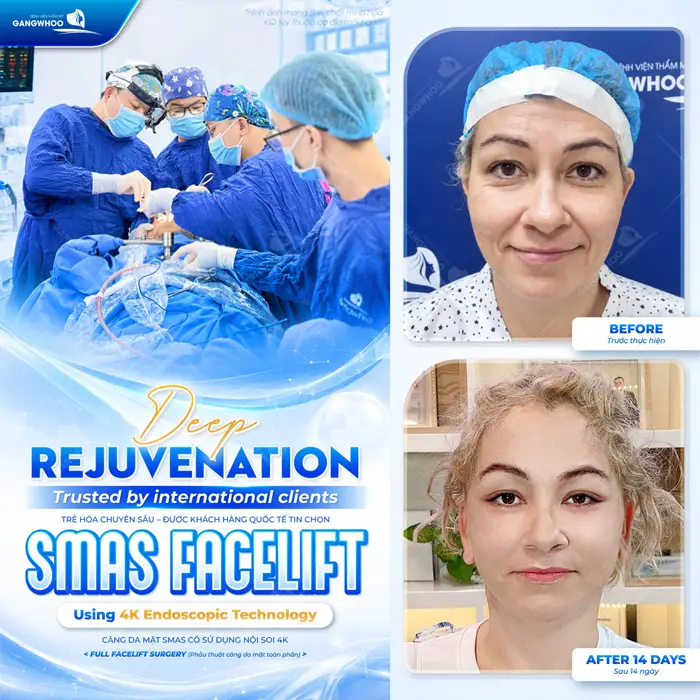 Căng da mặt Deep Plane trẻ hóa diện mạo đẹp chuyên sâu lựa chọn được khách quốc tế tin chọn